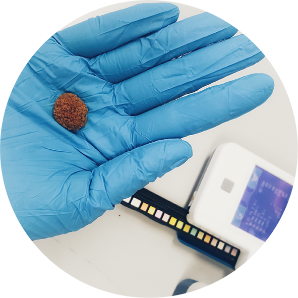 litiasis renal