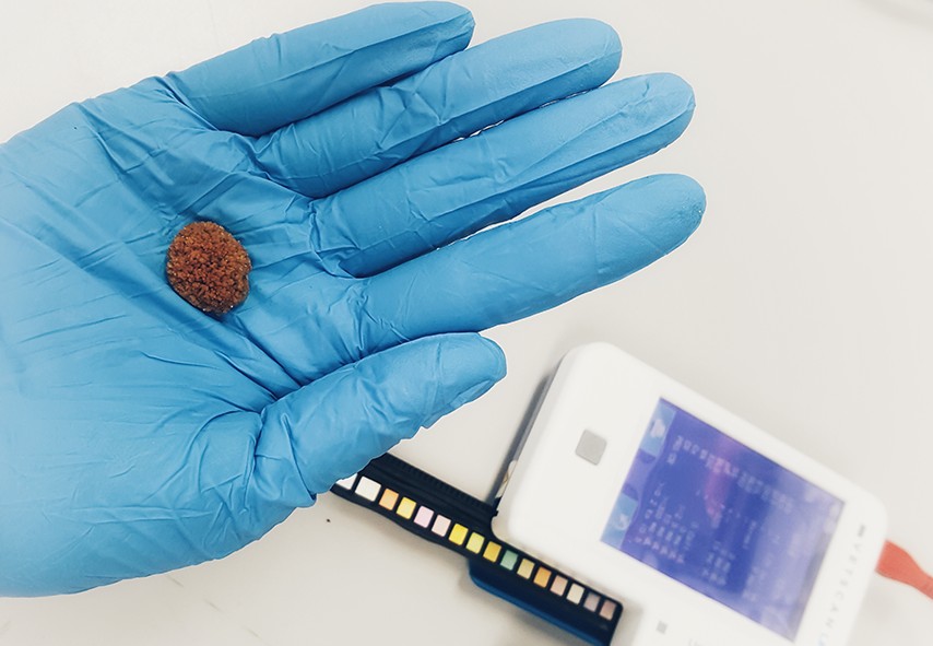 litiasis, calculos y piedras en el riñon